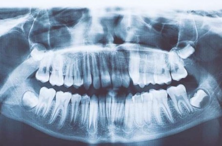 Sacan 526 dientes de la boca de un niño de 7 años